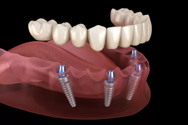 повна імплантація зубів ціна у 2026 році | PSL